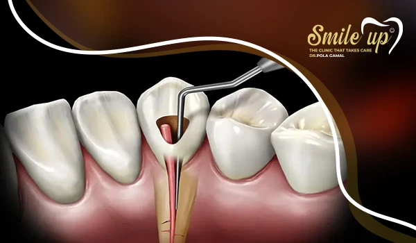 علاج الجذور