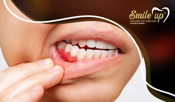 تجميل اللثة