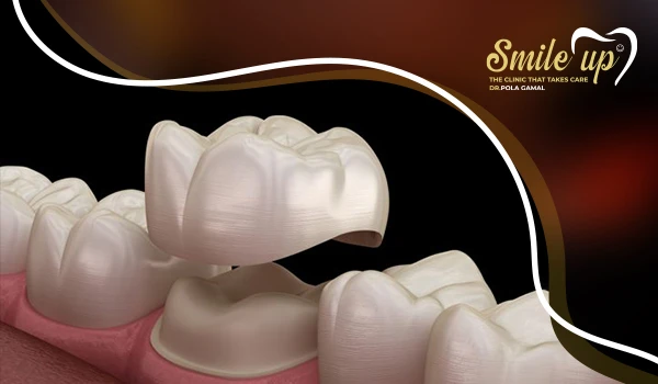 تركيب الأسنان