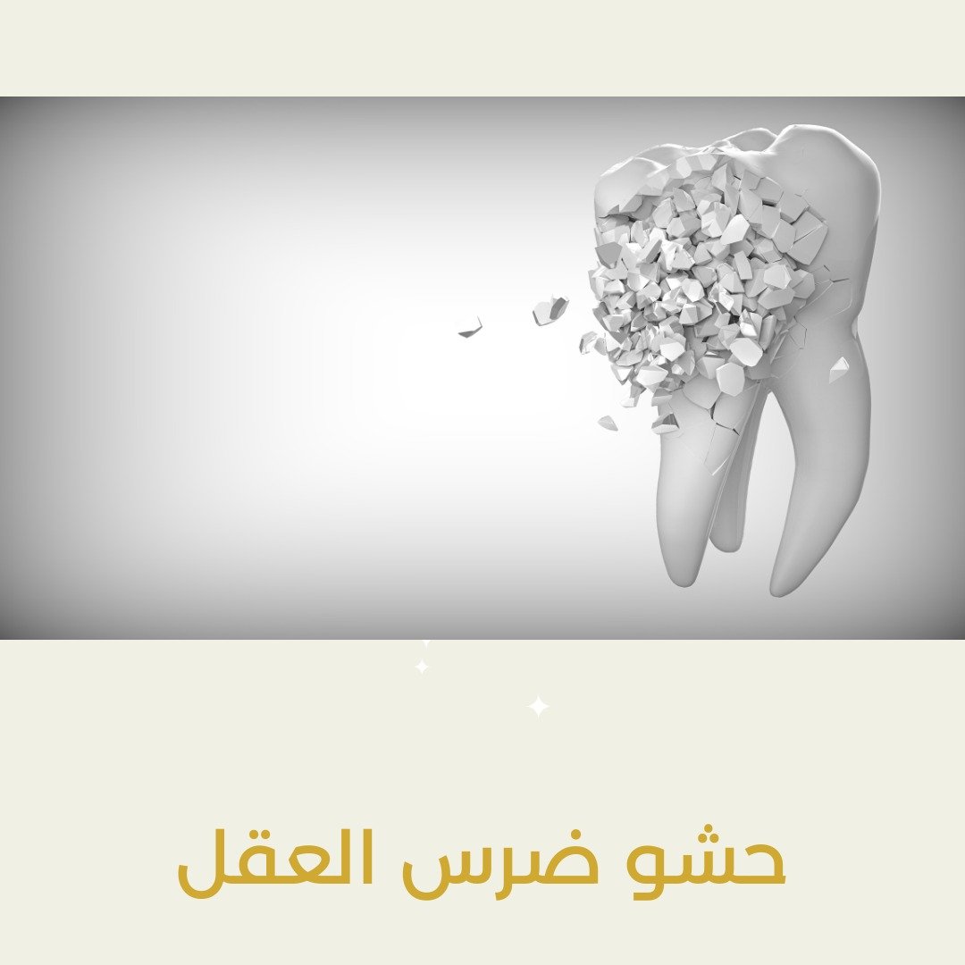 حشو ضرس العقل