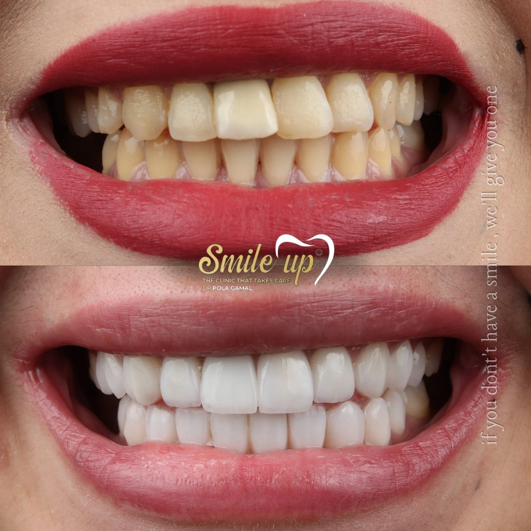 before and after cases_20241022_160301_0009