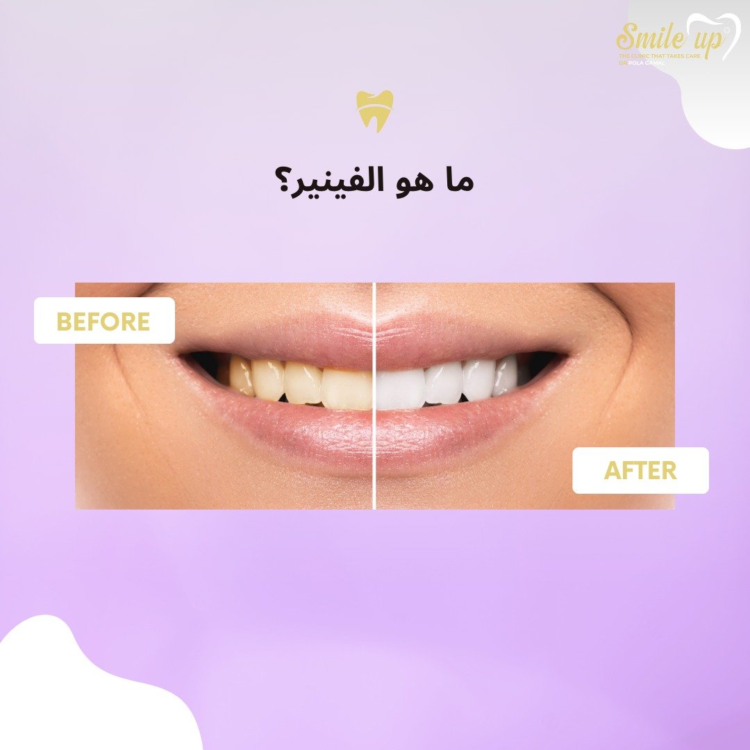 ما هو الفينير