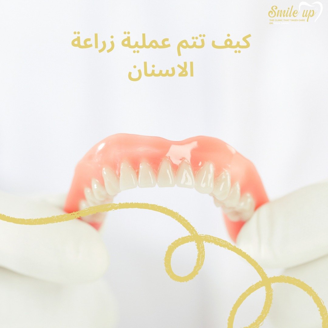 زراعة الاسنان