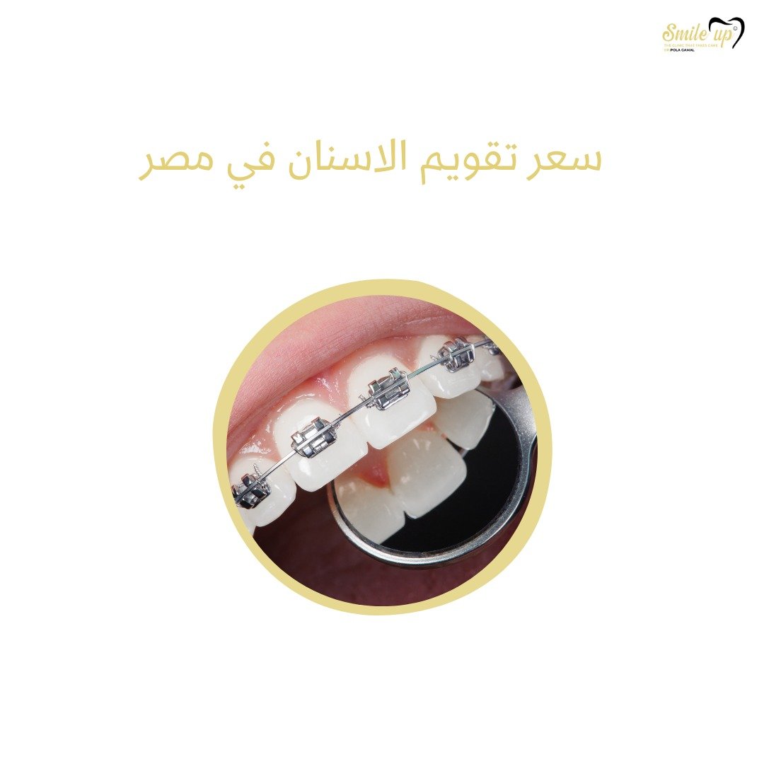 سعر التقويم وهل يمكن تقويم الأسنان بالتقسيط في مصر 2025