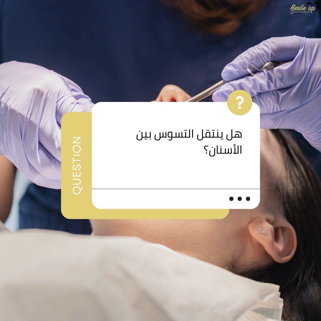 هل ينتقل التسوس بين الأسنان