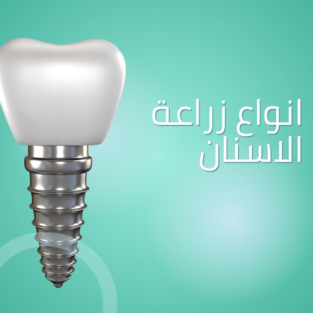 اهم 4 أنواع زراعة الأسنان في مصر