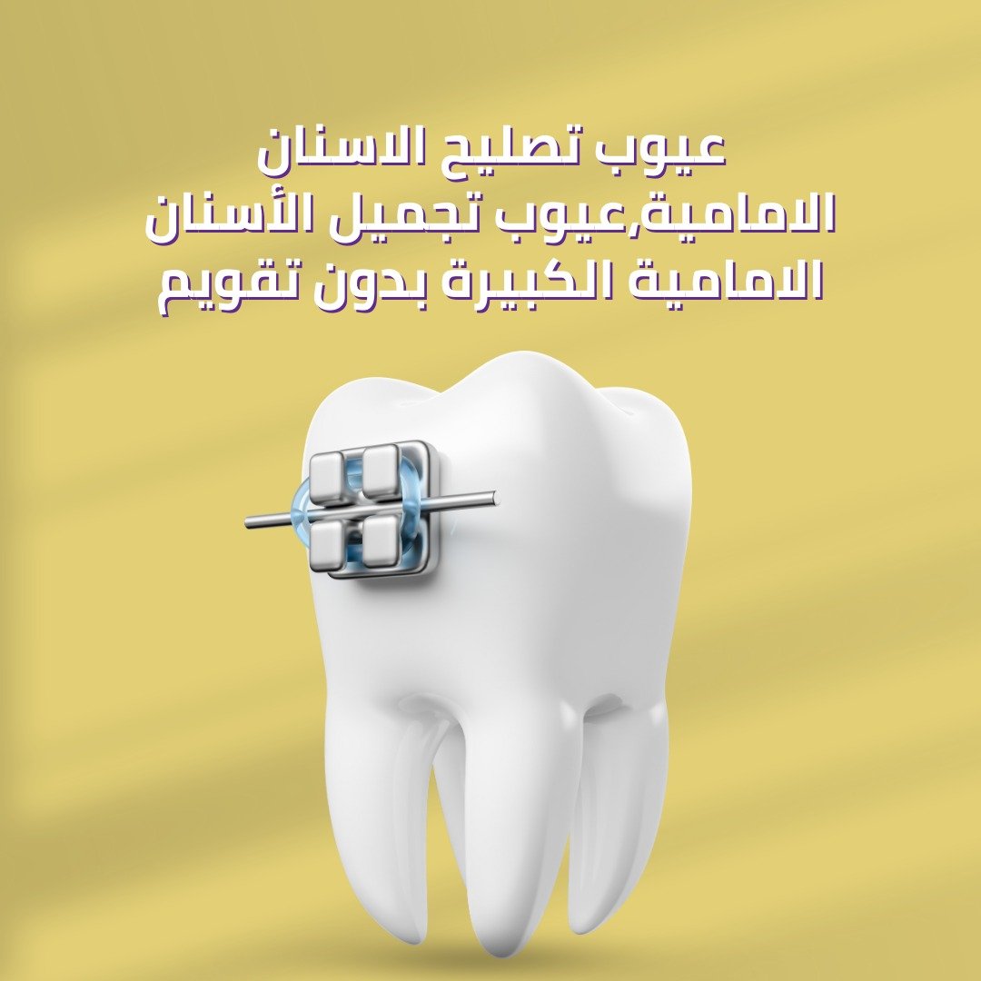 عيوب تصليح الاسنان الامامية عيوب تجميل الأسنان الامامية الكبيرة بدون تقويم