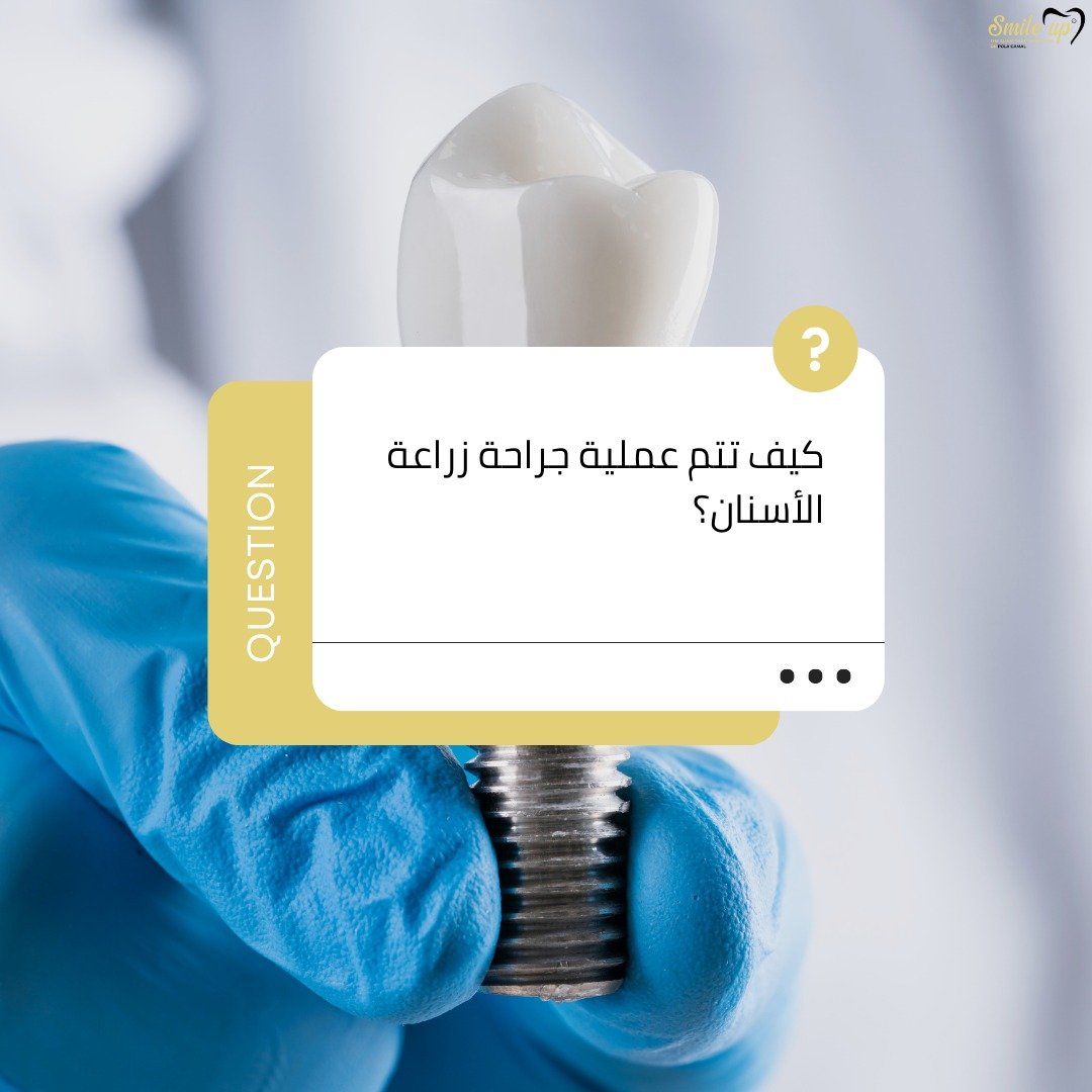 كيف تتم عملية جراحة زراعة الأسنان؟