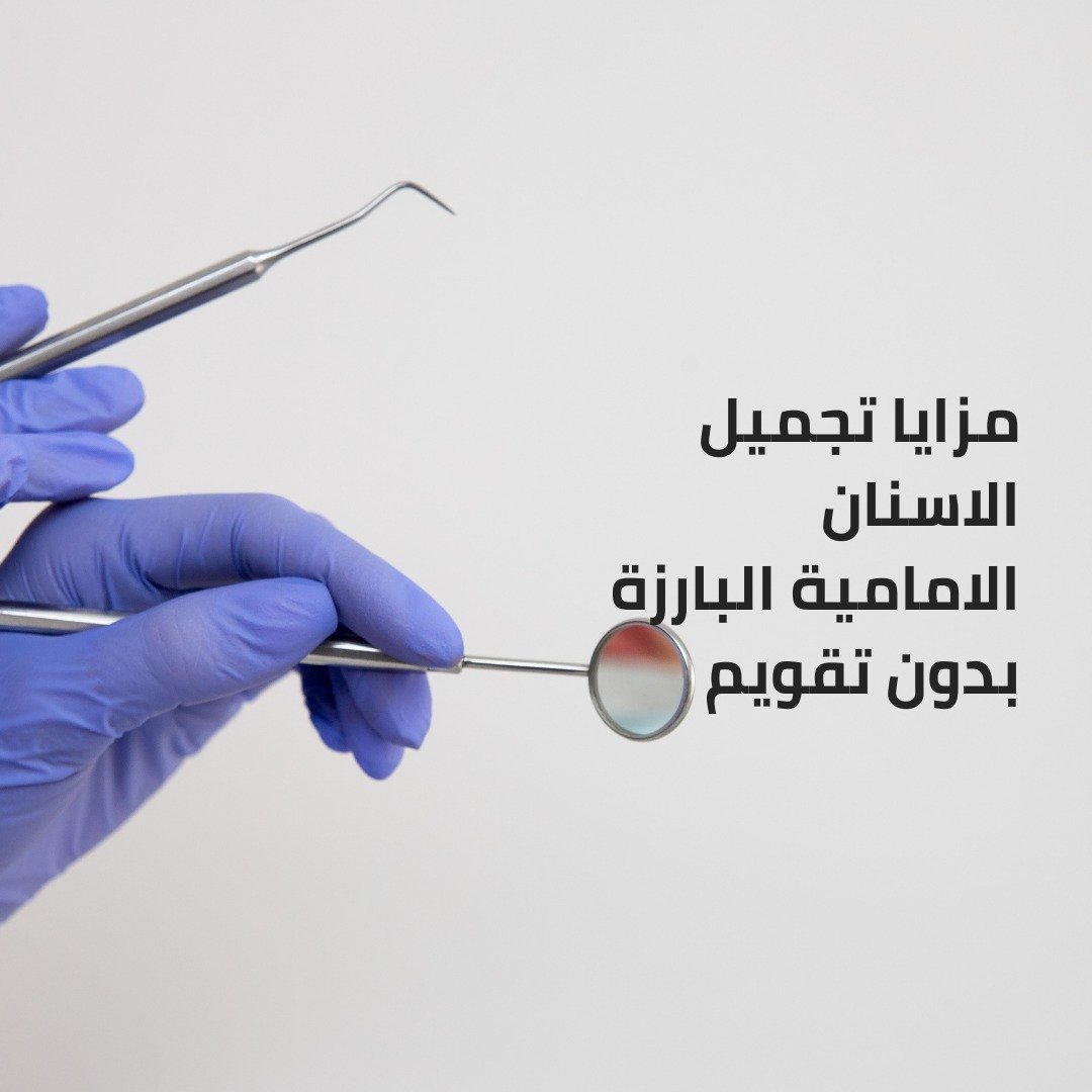 مزايا تجميل الاسنان الامامية البارزة بدون تقويم