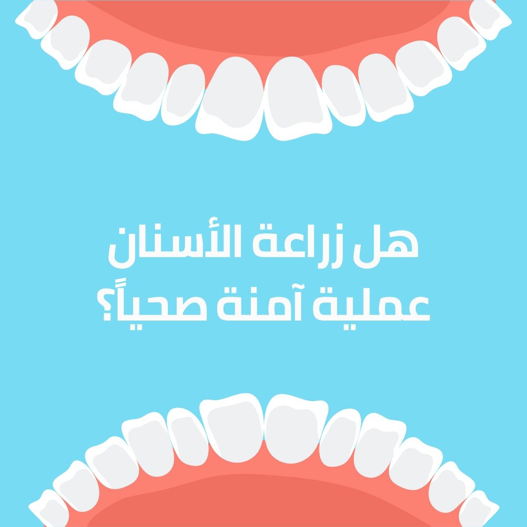 هل زراعة الأسنان عملية آمنة صحياً؟
